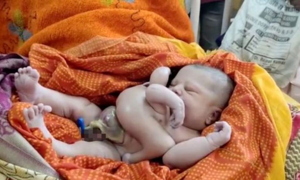 Baby Born with Four Legs