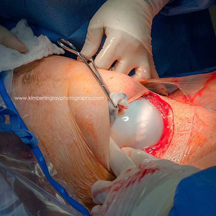 c-section-of-twins