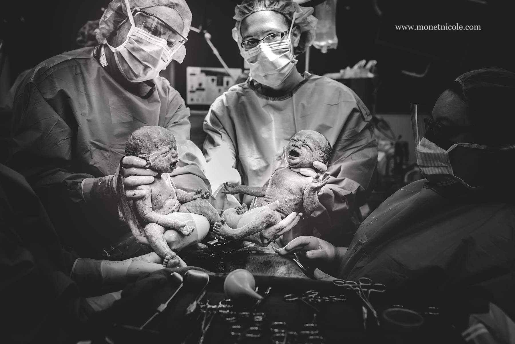 cesarean-birth-of-twins