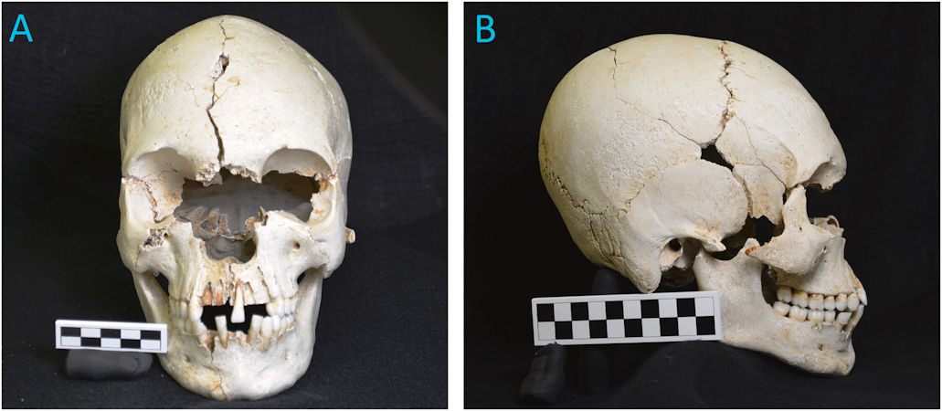 Ancient Caribbean Skull Shows Evidence Of Leprosy