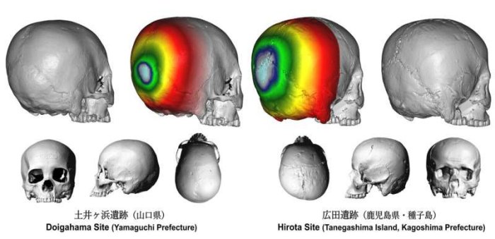  Japan's Ancient Practice Of Cranial Modification: The Case Of The Hirota People In Tanegashima