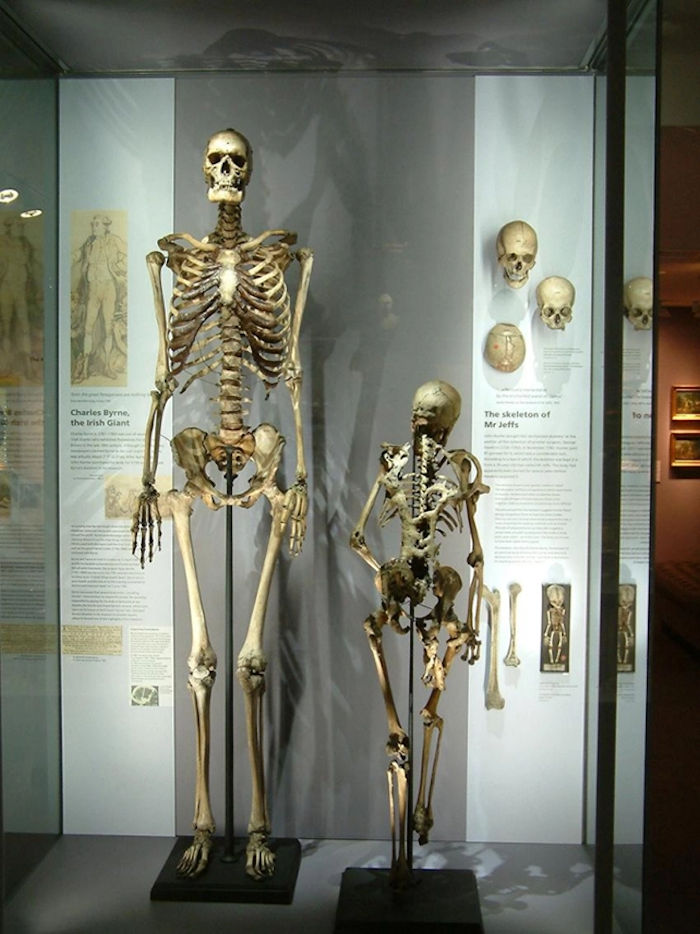 Skeleton Of Irish Giant Charles Byrne Will Not Be Displayed In The Hunterian Museum In London