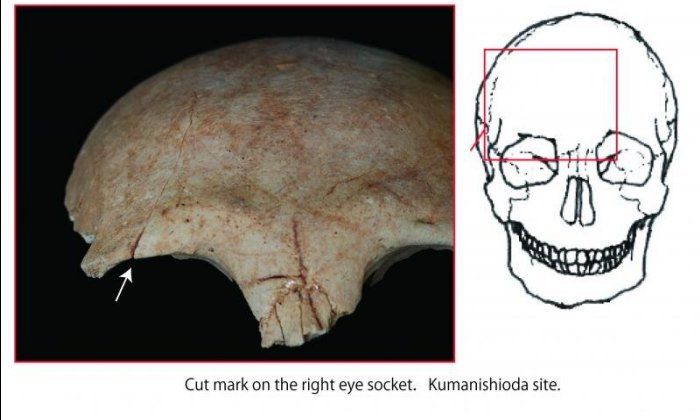 The trauma is slightly healed. However, because it seems to have been severe enough to have caused terrible damage to the person, it is likely perimortem. Credit: Chikushino City Board of Education